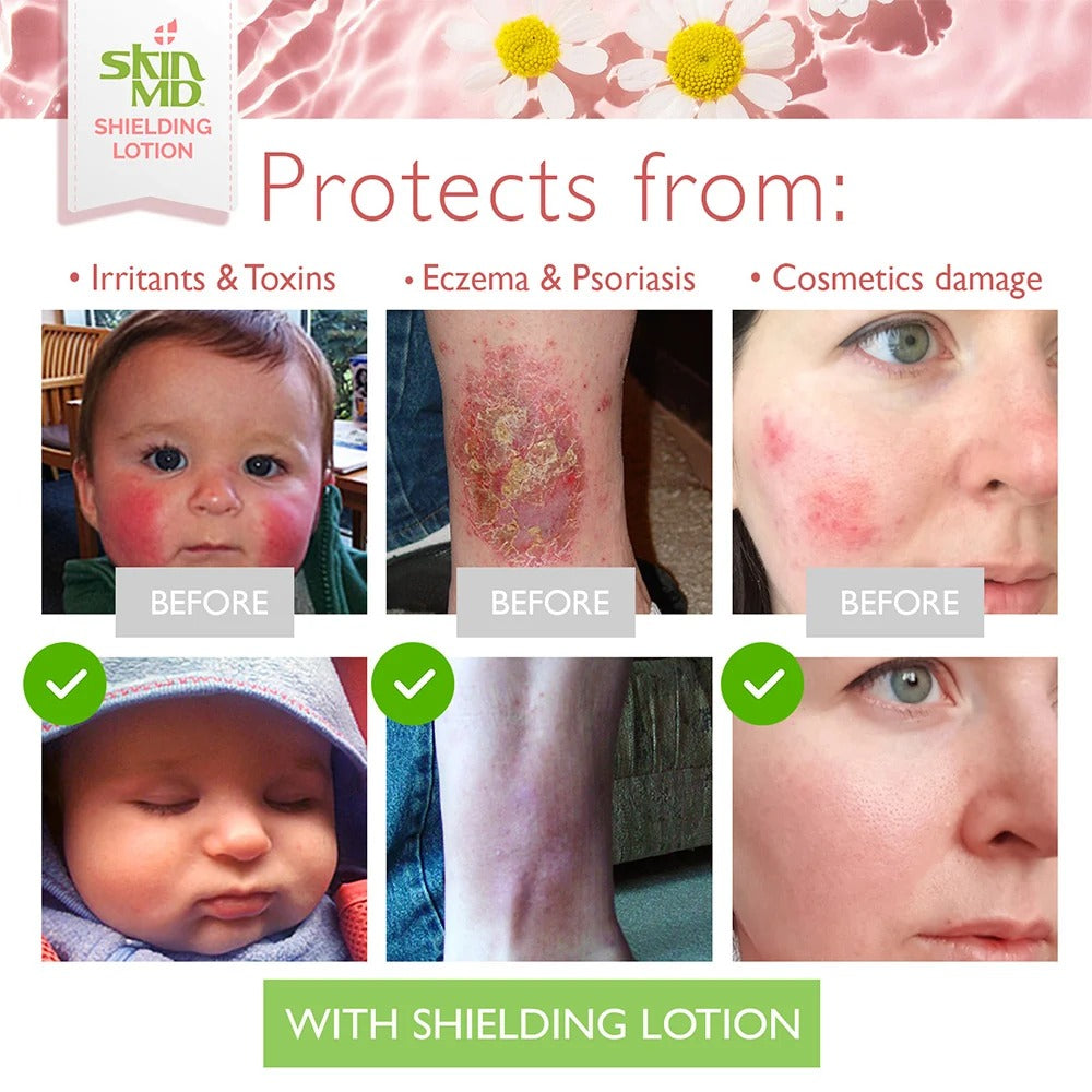 Skin MD Shielding Lotion | 8oz